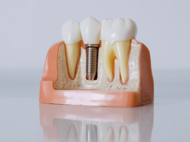 https://nhakhoathanhan.com/wp-content/uploads/2025/09/Rang-Implant-640x480.png